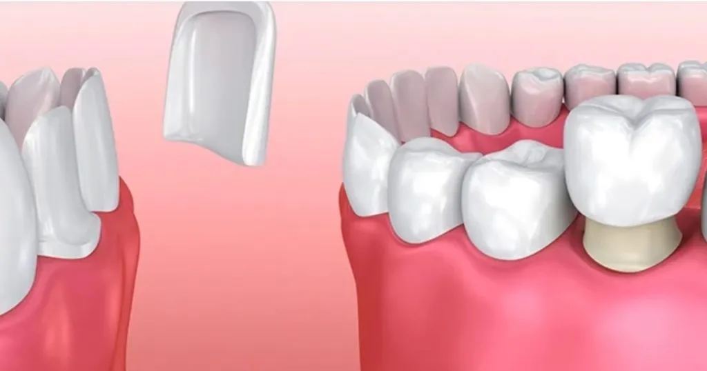 Teeth Whitening Treatment